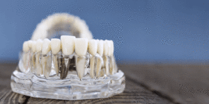 Dental Implant Model Showcasing Prosthetic Teeth on a Transparent Jaw for Educational